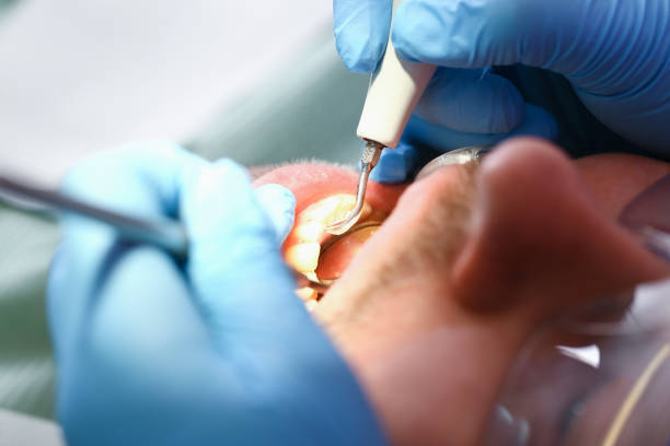 Best Emergency Dentist for Lost Fillings or Crowns in Upper Arlington, OH