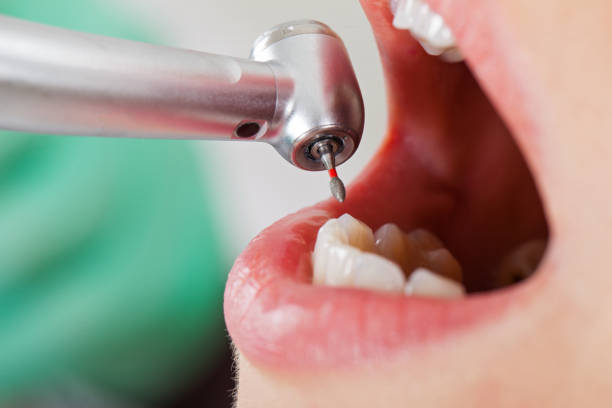 Best Emergency Root Canal Treatment in Upper Arlington, OH